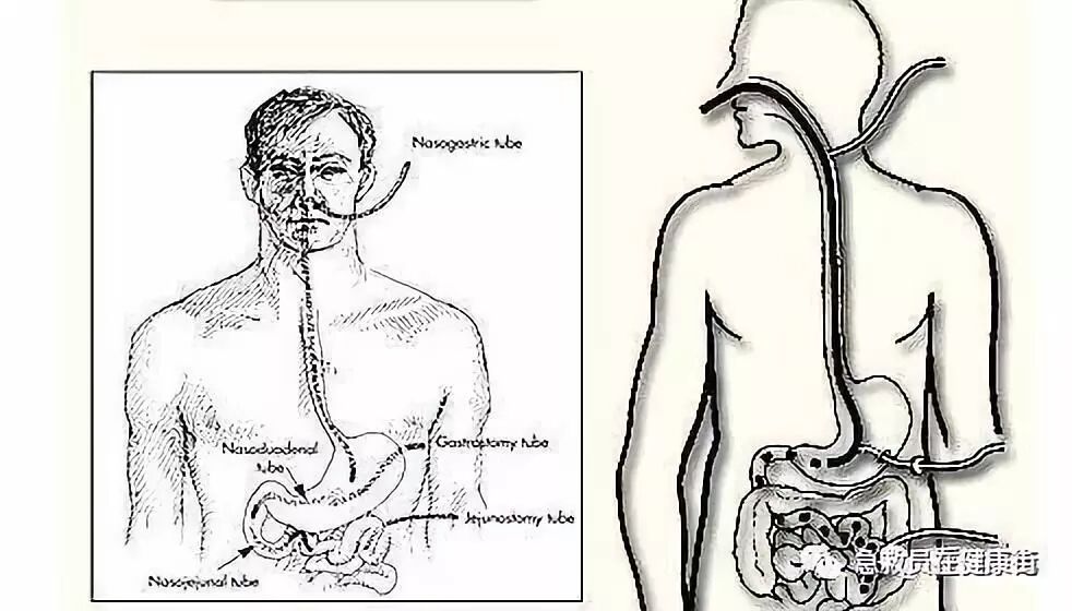 怎么拔鼻腔引流管胃管术（二）_https://www.jmylbn.com_新闻资讯_第64张