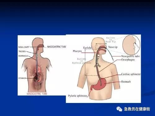 怎么拔鼻腔引流管胃管术（二）_https://www.jmylbn.com_新闻资讯_第1张