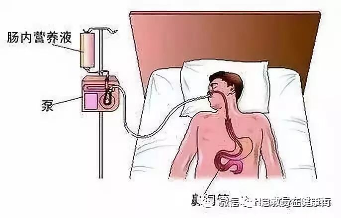 怎么拔鼻腔引流管胃管术（二）_https://www.jmylbn.com_新闻资讯_第26张
