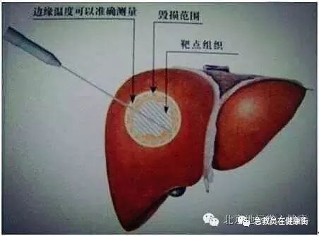 什么是电频消融中医---射频消融-上海聚慕医疗器械有限公司