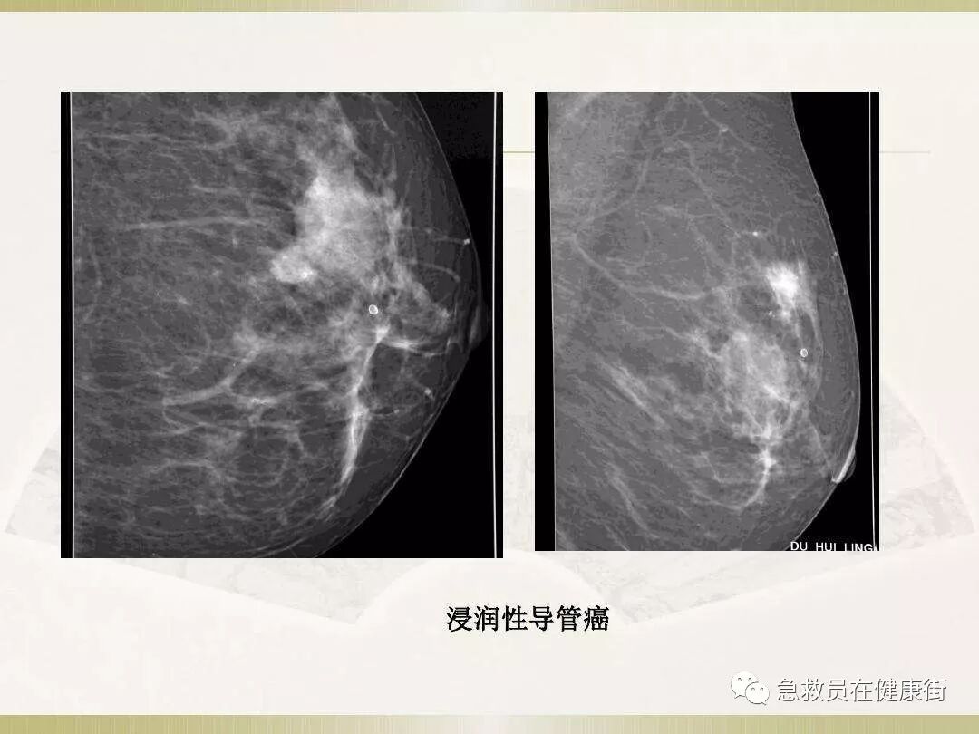 穿刺枪怎么升级乳腺穿刺术（三）_https://www.jmylbn.com_新闻资讯_第15张