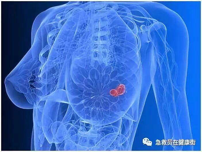穿刺枪怎么升级乳腺穿刺术（三）_https://www.jmylbn.com_新闻资讯_第7张