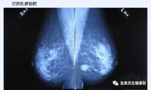 穿刺枪怎么升级乳腺穿刺术（三）_https://www.jmylbn.com_新闻资讯_第60张