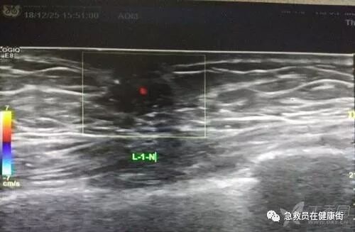 穿刺枪怎么升级乳腺穿刺术（二）_https://www.jmylbn.com_新闻资讯_第6张