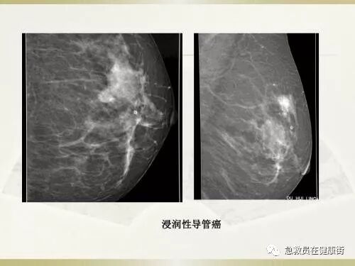 穿刺枪怎么升级乳腺穿刺术（二）_https://www.jmylbn.com_新闻资讯_第4张