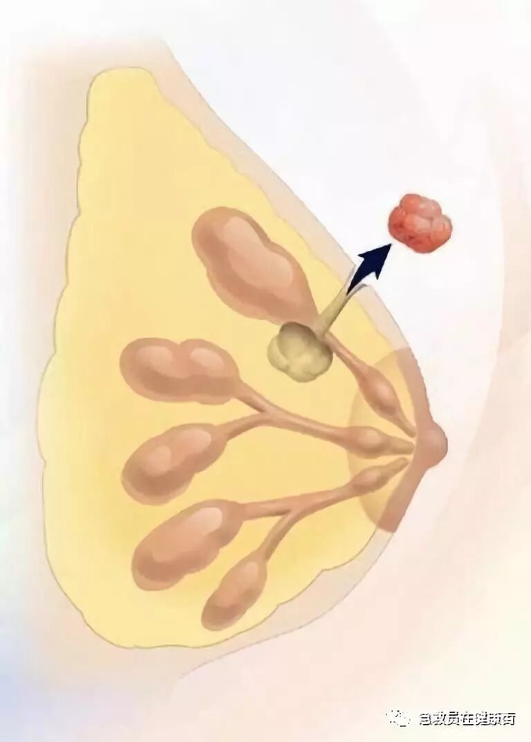 穿刺枪怎么升级乳腺穿刺术（二）_https://www.jmylbn.com_新闻资讯_第18张