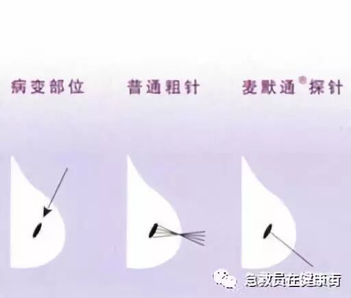 穿刺枪怎么升级乳腺穿刺术（二）_https://www.jmylbn.com_新闻资讯_第21张