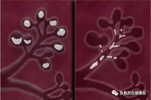 穿刺枪怎么升级乳腺穿刺术（二）_https://www.jmylbn.com_新闻资讯_第1张