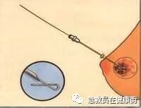 穿刺枪怎么升级乳腺穿刺术（二）_https://www.jmylbn.com_新闻资讯_第15张