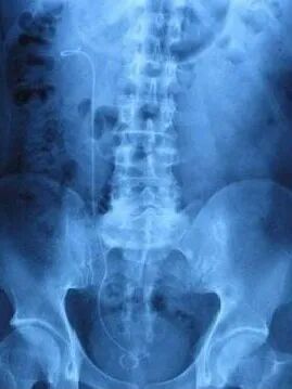 猪输尿管怎么吃人体内的“猪尾巴”--双J管_https://www.jmylbn.com_新闻资讯_第3张