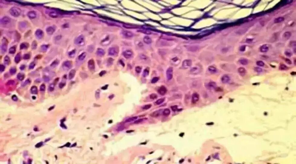 壳聚糖生物敷料治什么伤口愈合“神器”—壳聚糖功能性敷料_https://www.jmylbn.com_新闻资讯_第7张