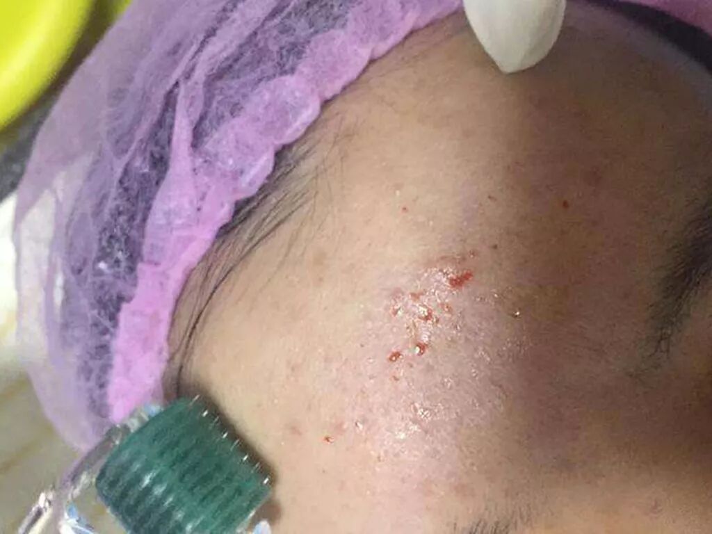 针清黑科技 能祛痘 也能毁容 悦肌者容 微信公众号文章阅读 Wemp