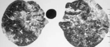 肺泡蛋白沉积症的影像识别，一文搞定！│以影识病