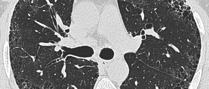 特发性肺纤维化影像识别，一文搞定！│以影识病