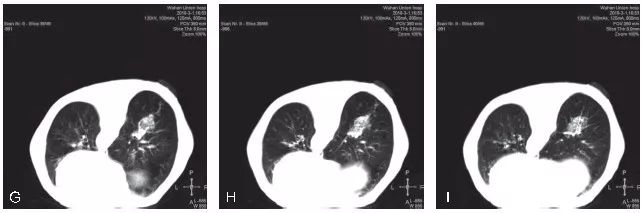 小結節/GGO 的穿刺活檢│臨床必備 健康 第5張