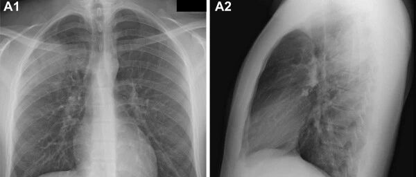21岁免疫力正常男性，出现咯血和皮疹，到底是什么疾病？