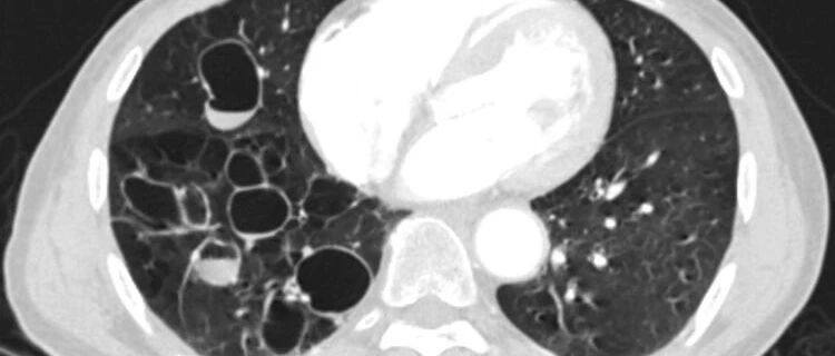 患者47岁，咳嗽咳痰，你的诊断是什么？│以影识病