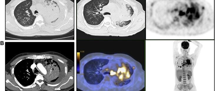 52岁男性，发热、咳嗽、胸痛、胸腔积液和左肺不张11个月，到底是什么原因？