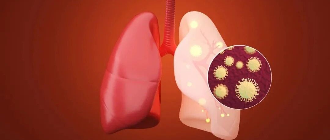 老年男性，咯血2年，肺部肿块伴有毛刺，结果竟然是......