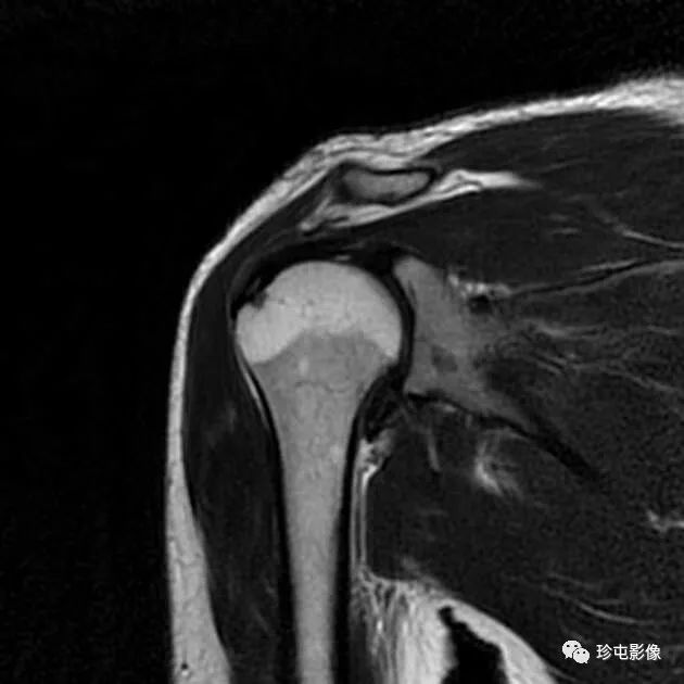 边缘撕裂-冈上肌腱
