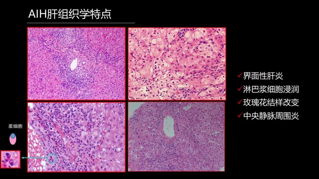 馬雄：20年鑽研自身免疫性肝病，爭研究型醫生金牌！ 健康 第17張