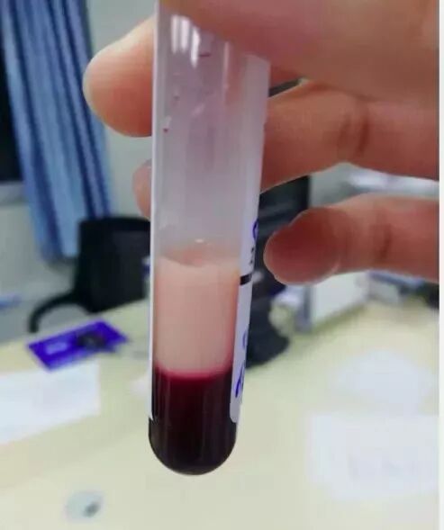 提醒一渴就喝奶茶小伙暴肥90多斤抽出猪油血更可怕的事出现了