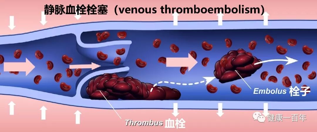 é­ç¤¾é¹ç‰ˆåŒ»å­¦ç™¾ç§' ä¸‹è‚¢æ·±é™è„‰è¡€æ 