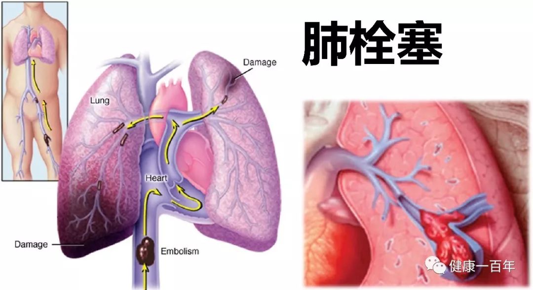 魏社鹏版医学百科 下肢深静脉血栓形成 健康一百年 微信公众号文章阅读 Wemp