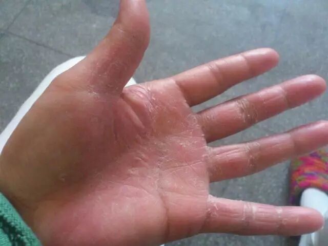 手足癣易复发，注意饮食很重要！