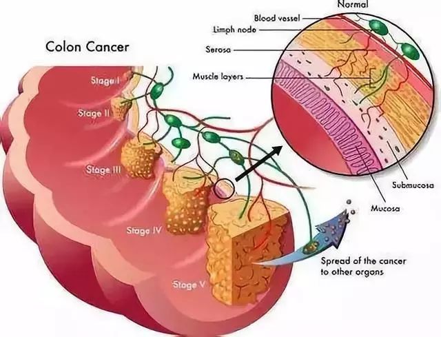 結腸癌發出的5大信號，你接收到了嗎？ 健康 第2張