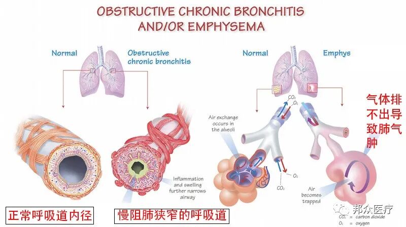 呼吸机怎么制氧慢阻肺是配制氧机好还是呼吸机好？_https://www.jmylbn.com_新闻资讯_第3张