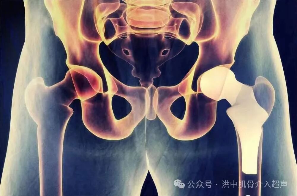 髋关节滑膜炎超声诊断及引导下的介入治疗