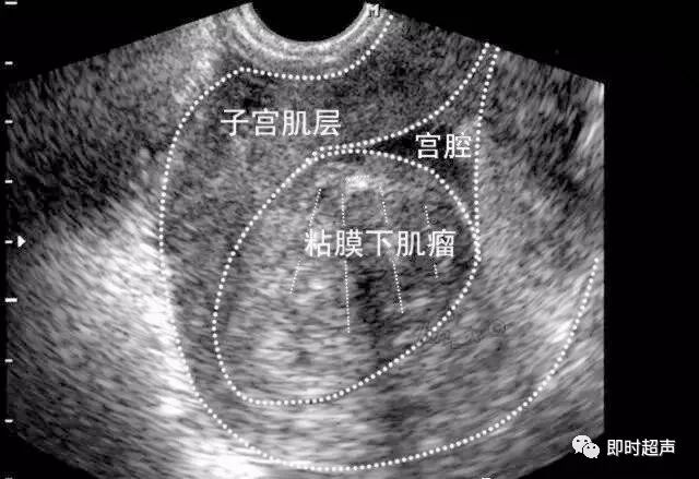 临床必学:子宫肌瘤不同类型的超声诊断,一文总结_医学界-助力医生临床