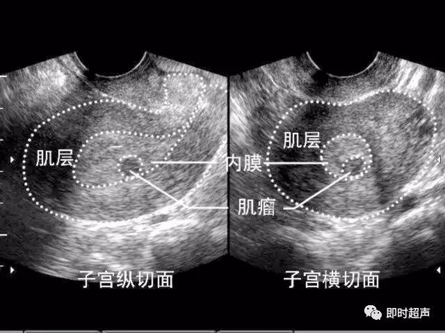 临床必学:子宫肌瘤不同类型的超声诊断,一文总结_医学界-助力医生临床