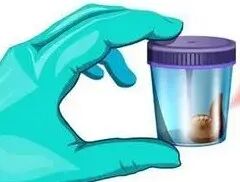 化验大便怎么采集【检验科普小知识】如何正确采集大、小便标本_https://www.jmylbn.com_新闻资讯_第12张