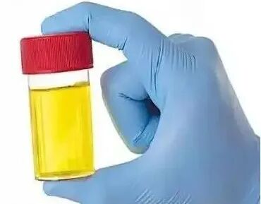 化验大便怎么采集【检验科普小知识】如何正确采集大、小便标本_https://www.jmylbn.com_新闻资讯_第5张