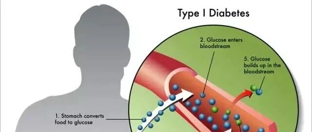 《Cell Stem Cell》：PSC衍生的胰腺内胚层细胞，使1型糖尿病患者成功分泌胰岛素