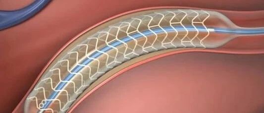 心脏支架从1.3万降到700，竟还有利润，那以前回扣是多高？
