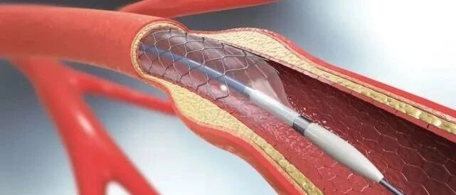 心脏支架从1.3万降至700元！将为百姓节约109亿，能放心使用吗？