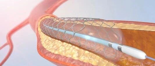 心脏支架从万元降至百元，并不是 “医生拿不到回扣了”那么简单