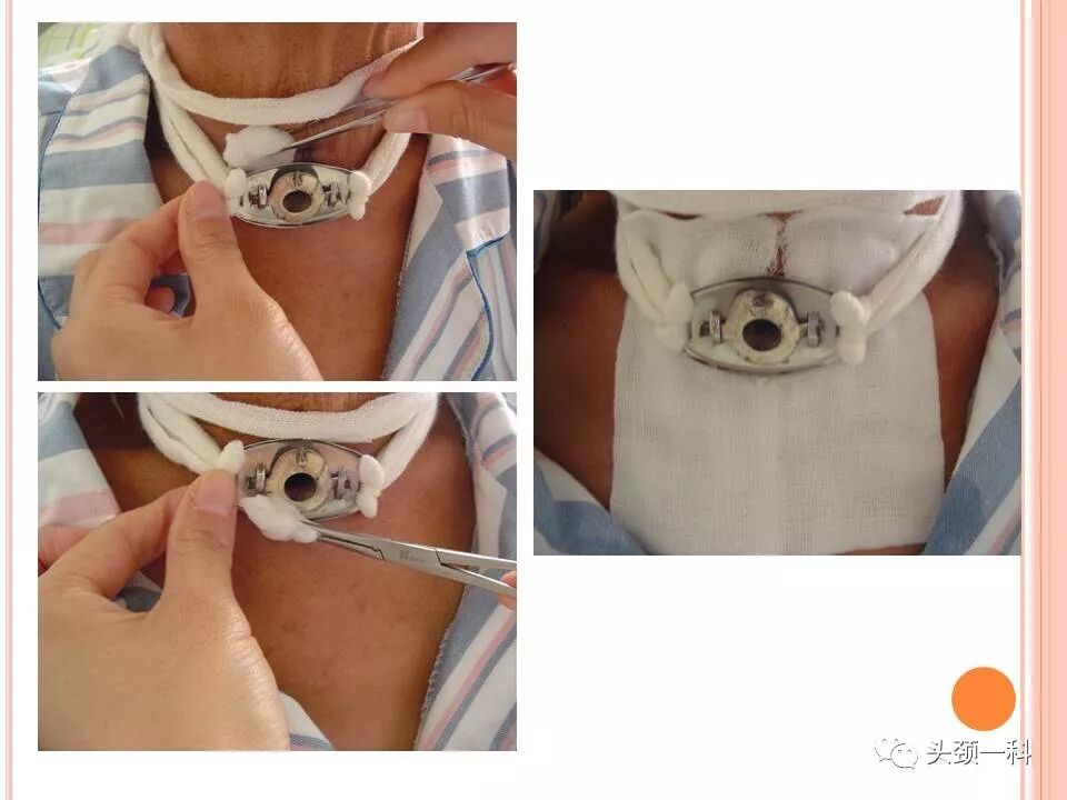 气管套管怎么换药您知道带着气管套管回家以后需要如何护理吗？_https://www.jmylbn.com_新闻资讯_第8张