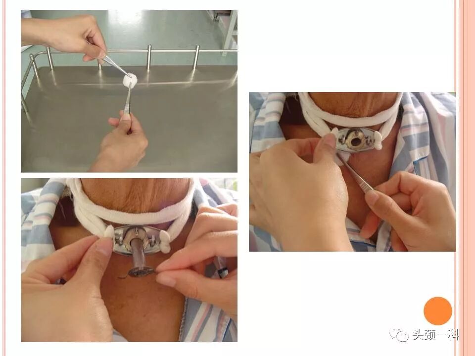 气管套管怎么换药您知道带着气管套管回家以后需要如何护理吗？_https://www.jmylbn.com_新闻资讯_第7张