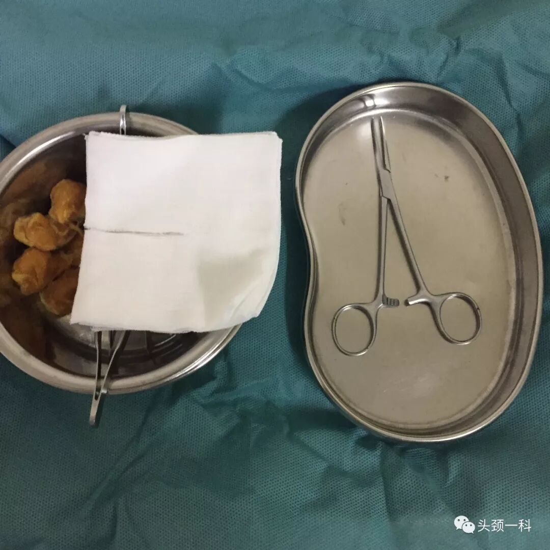 气管套管怎么换药您知道带着气管套管回家以后需要如何护理吗？_https://www.jmylbn.com_新闻资讯_第5张