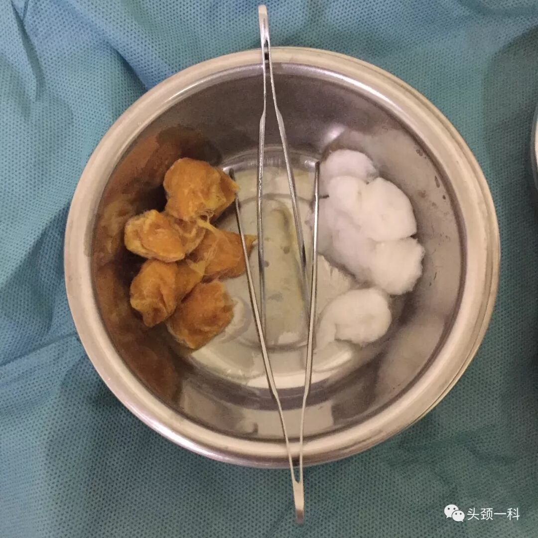 气管套管怎么换药您知道带着气管套管回家以后需要如何护理吗？_https://www.jmylbn.com_新闻资讯_第4张