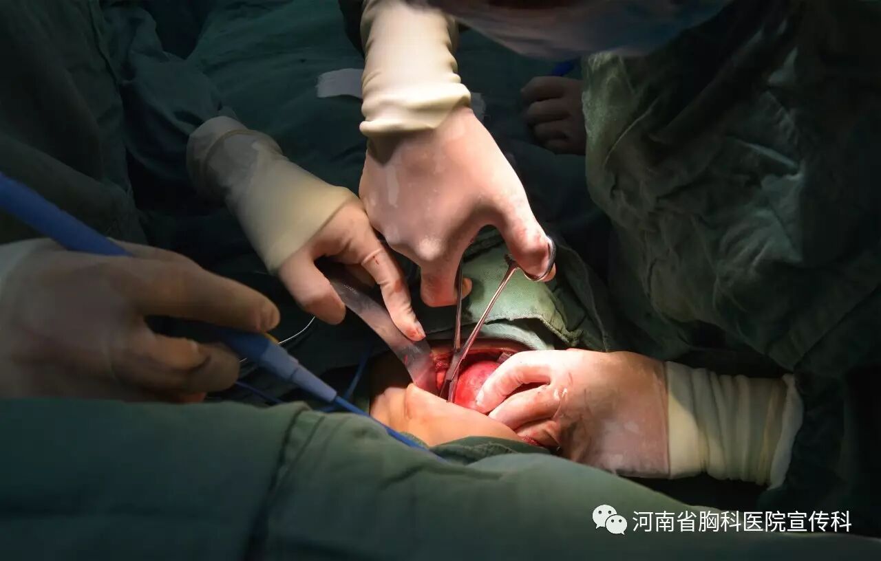钱如林主任迎难而上,完整切除肿瘤,整个过程一气呵成,手术