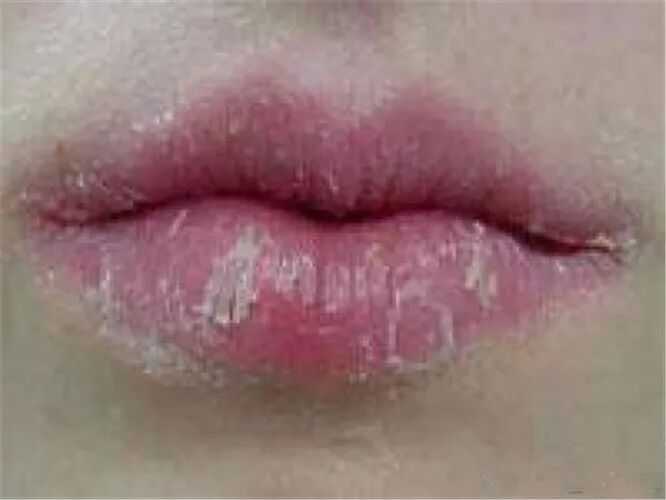 剥脱性唇炎中医有用吗图片_有来医生