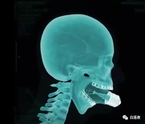 口腔灯为什么无影转载·科普｜为什么灯泡吞得进去，却拿不出来？_https://www.jmylbn.com_新闻资讯_第7张