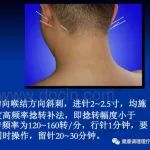 “醒脑开窍针刺法”治疗中风病的临床应用！