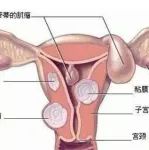 子宫肌瘤原来是这么来的，看完我目瞪口呆！