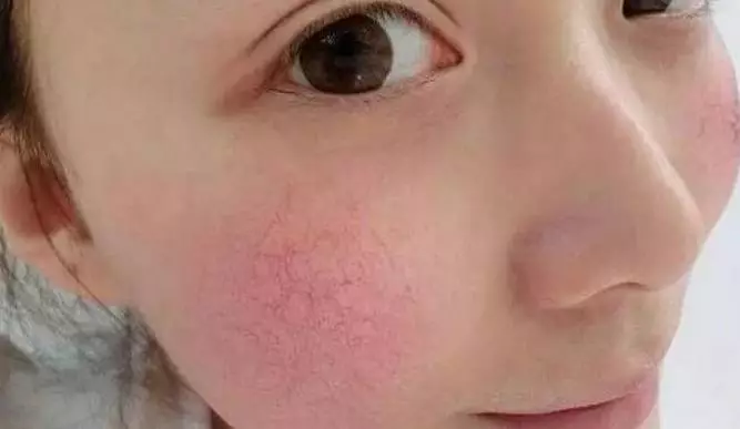 研 究 | 日 光 照 射 對 女 性 面 部 皮 膚 老 化 的 影 響 研 究 | 日 光 照 射 對 女 性 面 部 皮 膚 老 化 的 影 響